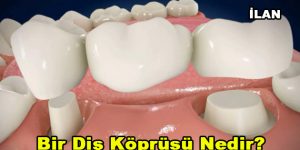 Bir diş köprüsü nedir?