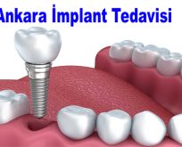 Ankara implant tedavisi nasıl yapılır aşamalar nelerdir?