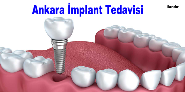 Ankara implant tedavisi nasıl yapılır aşamalar nelerdir?