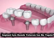 İmplant İçin Kemik Yetersiz İse Ne Yapılır? İmplant tedavisi için