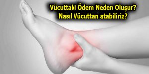 Vücuttaki Ödem Neden Oluşur? Nasıl Vücuttan atabiliriz?