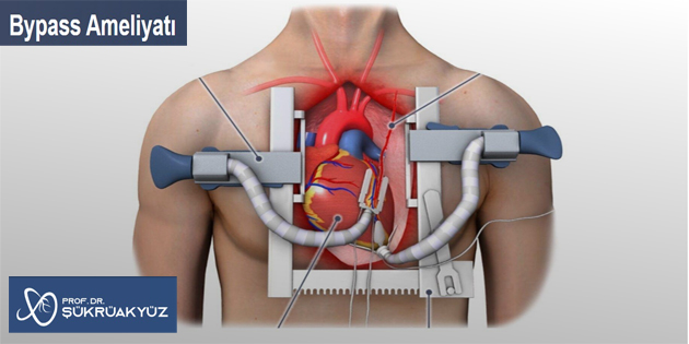 Anjiyo ve Stent Yetersizse Çözüm Ne Zaman BYPASS Gerekir?