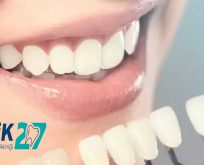 Lamina Veneer Kronlar Nedir