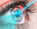 Lasik Göz Ameliyatı Nedir? Kimler İçin Uygundur?
