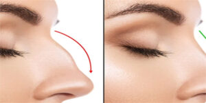 Rinoplasti Nedir ve Kimler Yaptırmalı?