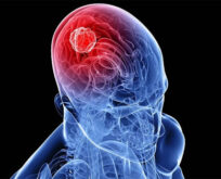 Beyin Tümörü Ameliyatları: Hayati Müdahaleler