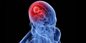 Beyin Tümörü Ameliyatları: Hayati Müdahaleler