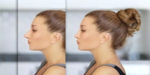 Burun Estetiği (Rinoplasti) Nedir?