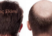 En İyi 10 Saç Ekimi Kliniği Saç dökülmesi çoğu kişi