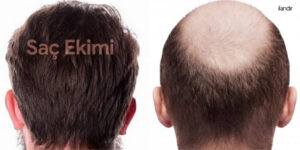 En İyi 10 Saç Ekimi Kliniği