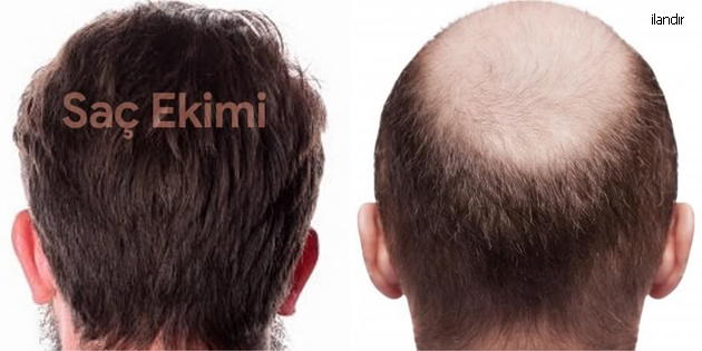 En İyi 10 Saç Ekimi Kliniği