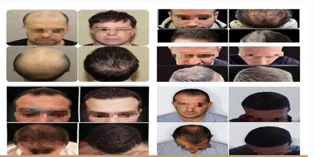 VIP трансплантация на коса в Турция Лукс и перфектни резултати с Turhair